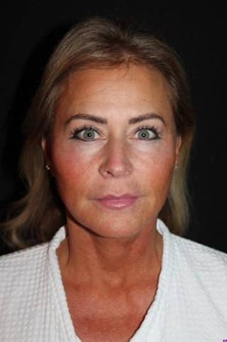 Facelift Before & After Gallery - Patient 104007 - Image 2