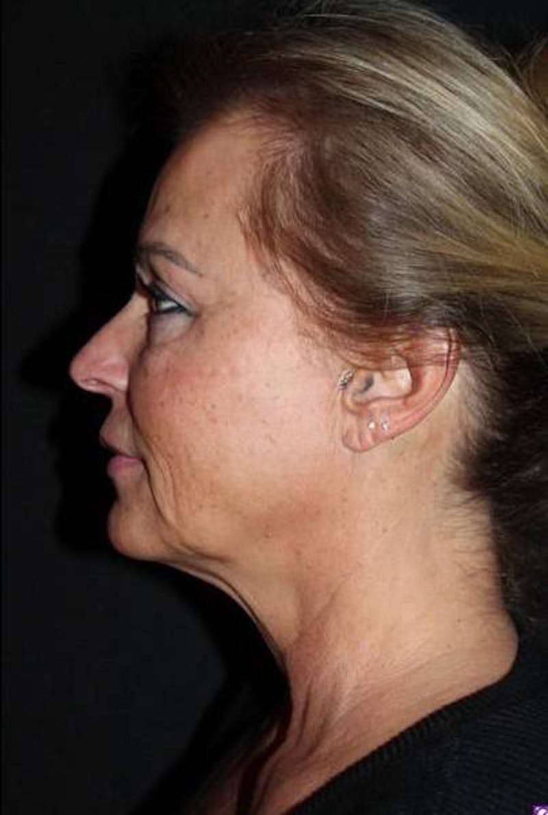 Facelift Before & After Gallery - Patient 104007 - Image 5