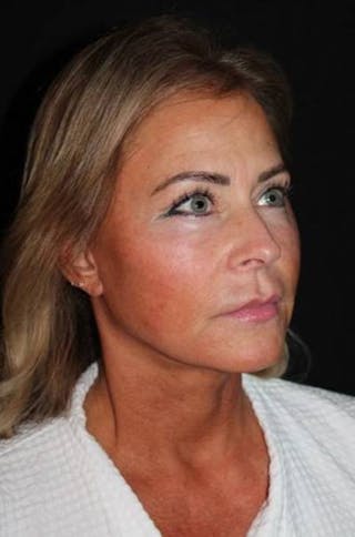 Facelift Before & After Gallery - Patient 104007 - Image 8