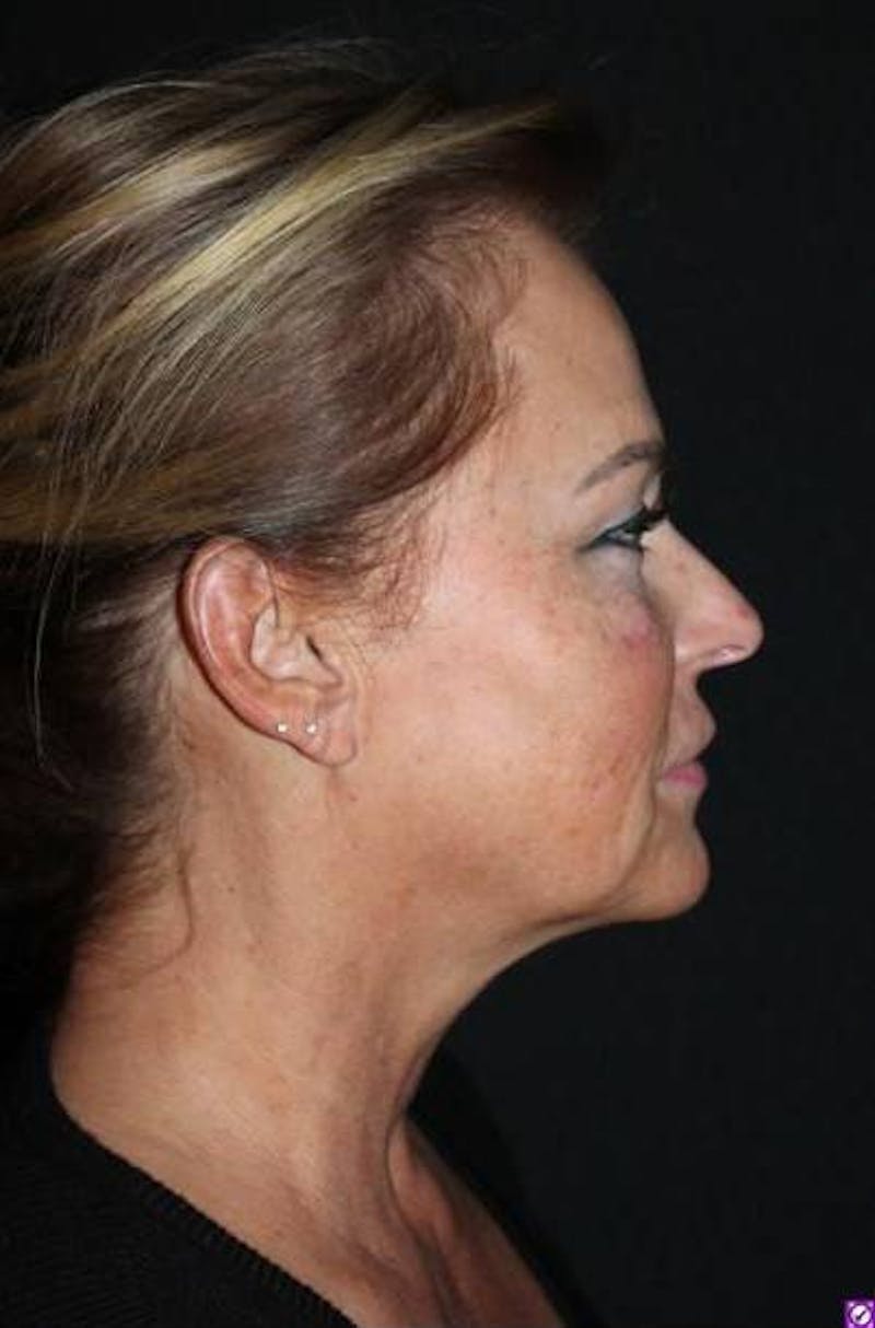 Facelift Before & After Gallery - Patient 104007 - Image 9