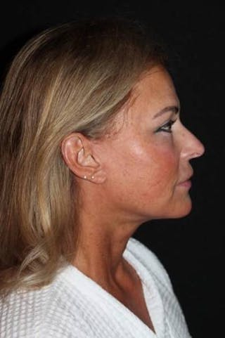 Facelift Before & After Gallery - Patient 104007 - Image 10