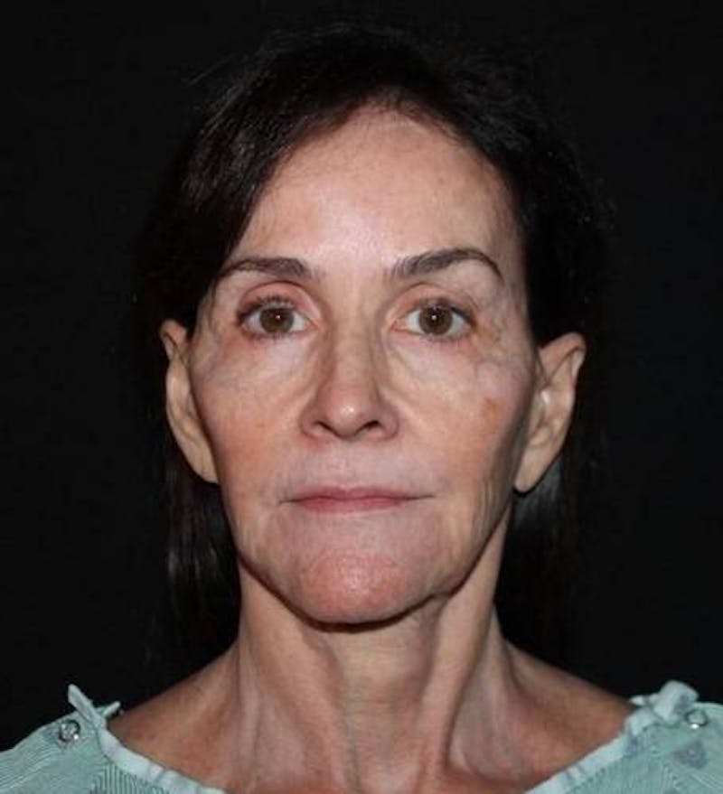 Facelift Before & After Gallery - Patient 343672 - Image 1
