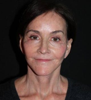 Facelift Before & After Gallery - Patient 343672 - Image 2