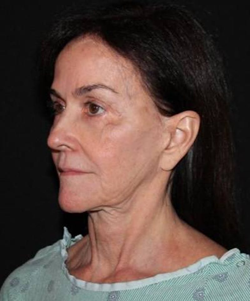 Facelift Before & After Gallery - Patient 343672 - Image 3