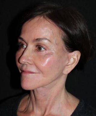 Facelift Before & After Gallery - Patient 343672 - Image 4
