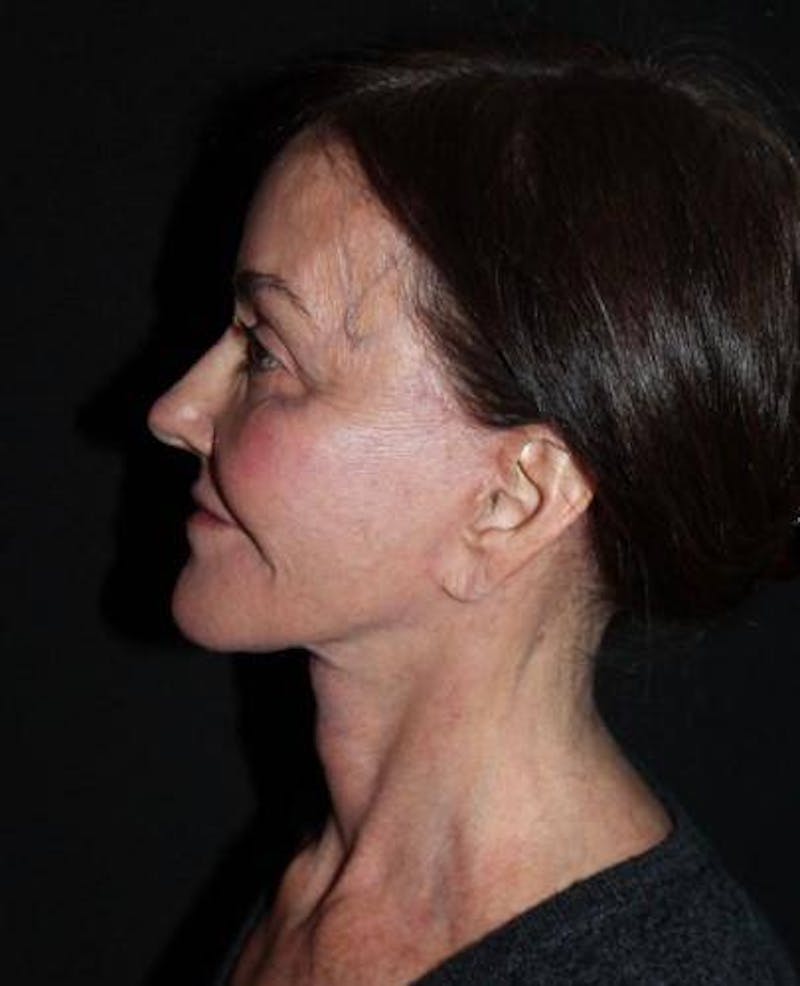 Facelift Before & After Gallery - Patient 343672 - Image 6
