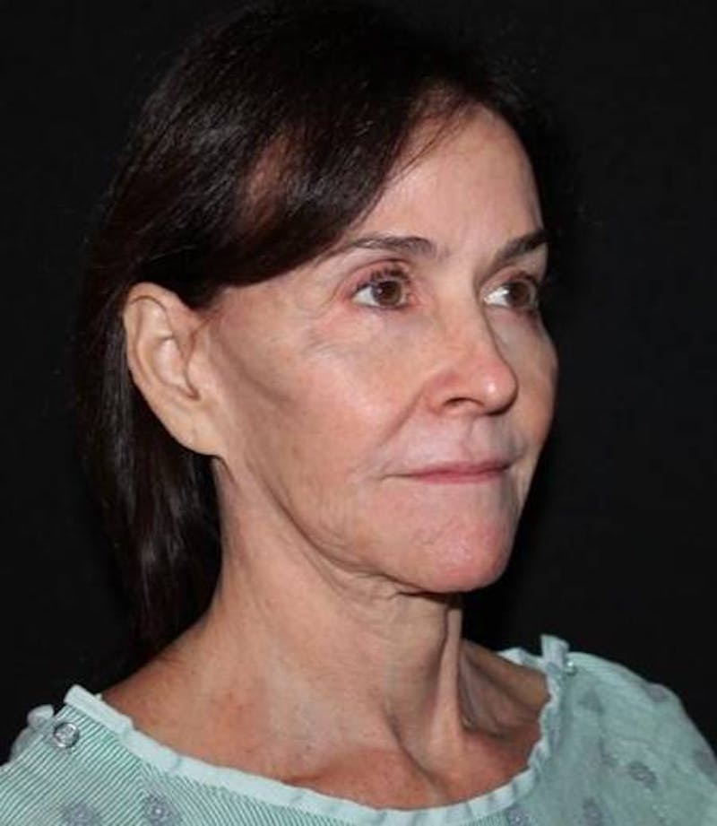 Facelift Before & After Gallery - Patient 343672 - Image 7