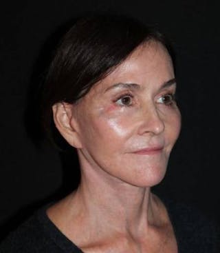 Facelift Before & After Gallery - Patient 343672 - Image 8