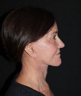 Facelift Before & After Gallery - Patient 343672 - Image 10