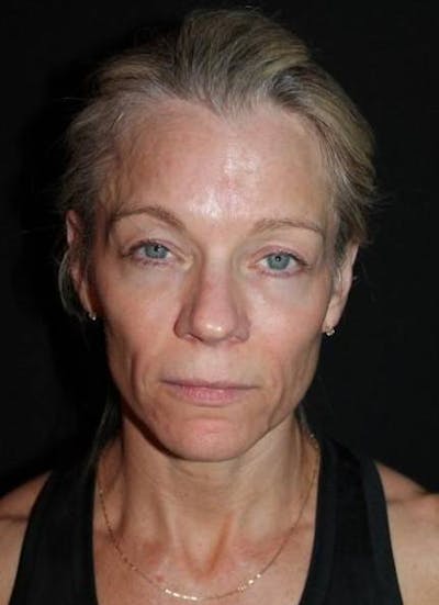 Facelift Before & After Gallery - Patient 374683 - Image 1