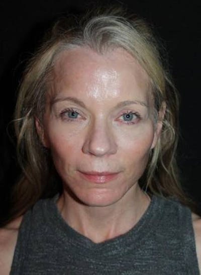 Facelift Before & After Gallery - Patient 374683 - Image 2