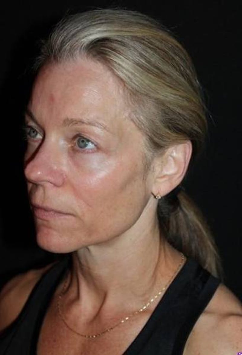 Facelift Before & After Gallery - Patient 374683 - Image 3