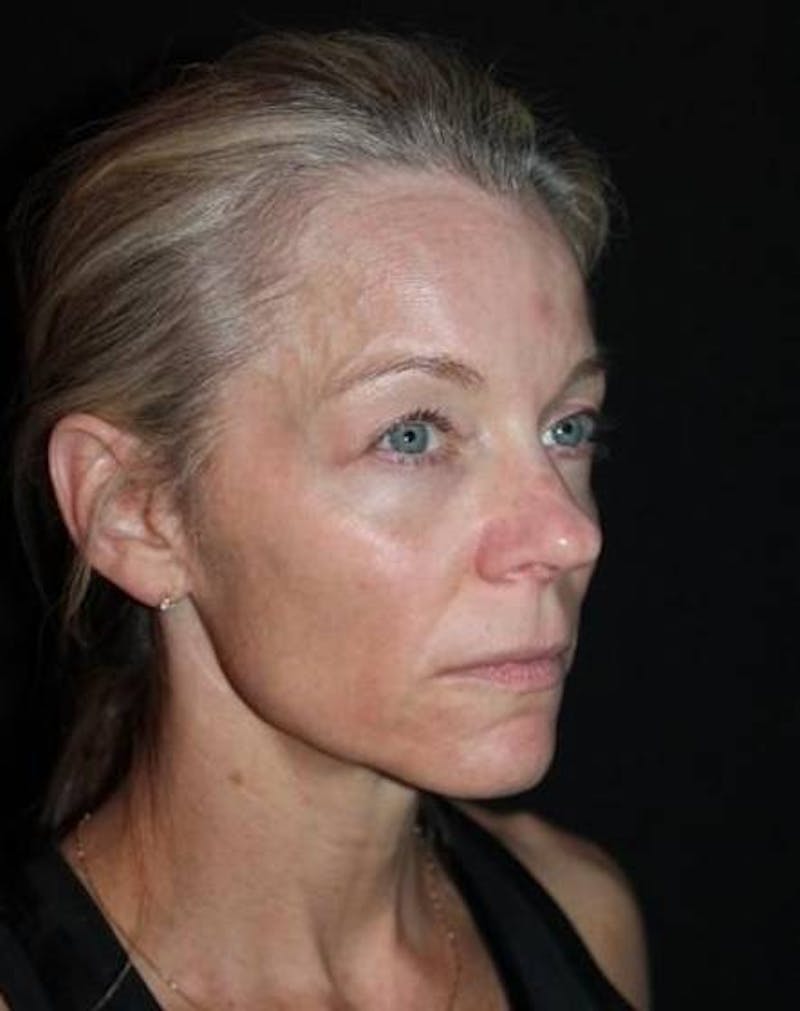 Facelift Before & After Gallery - Patient 374683 - Image 7