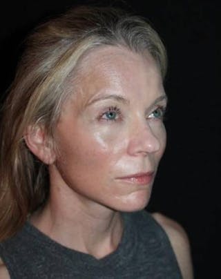 Facelift Before & After Gallery - Patient 374683 - Image 8