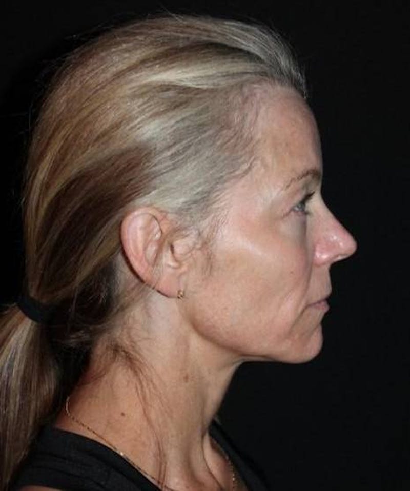 Facelift Before & After Gallery - Patient 374683 - Image 9
