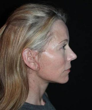 Facelift Before & After Gallery - Patient 374683 - Image 10