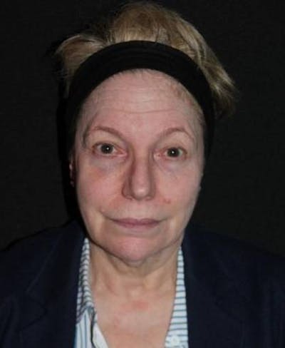 Facelift Before & After Gallery - Patient 384909 - Image 1