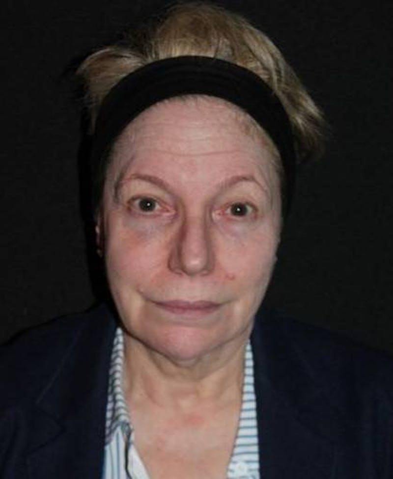 Facelift Before & After Gallery - Patient 384909 - Image 1