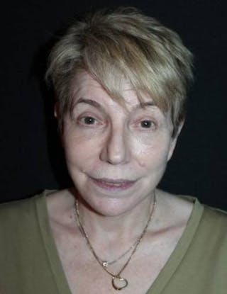 Facelift Before & After Gallery - Patient 384909 - Image 2