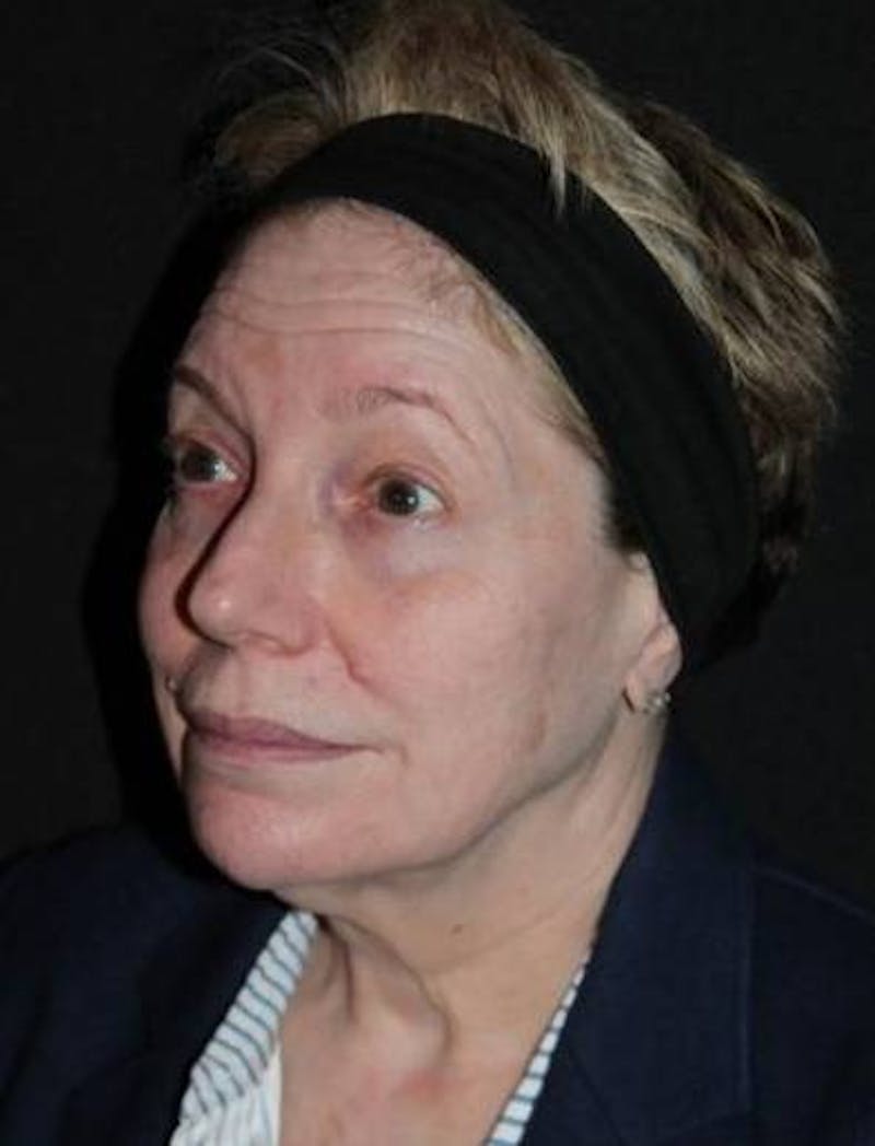 Facelift Before & After Gallery - Patient 384909 - Image 3