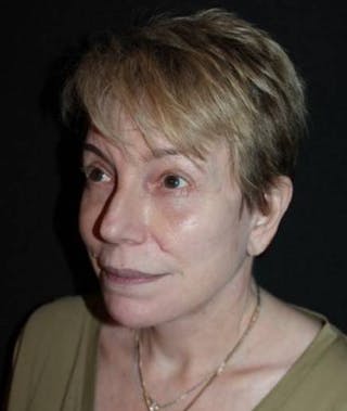 Facelift Before & After Gallery - Patient 384909 - Image 4