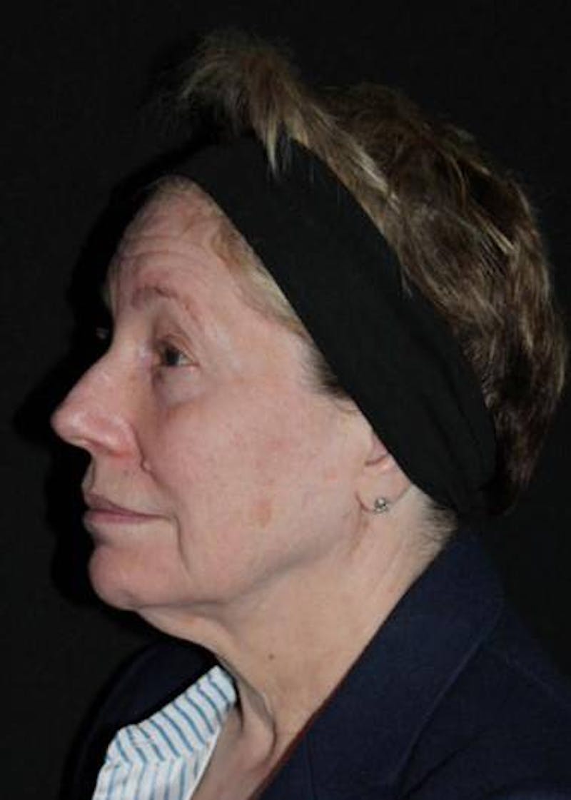 Facelift Before & After Gallery - Patient 384909 - Image 5