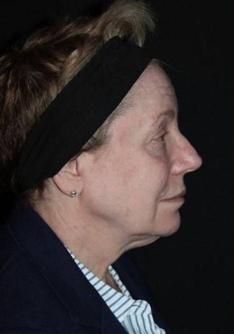 Facelift Before & After Gallery - Patient 384909 - Image 9