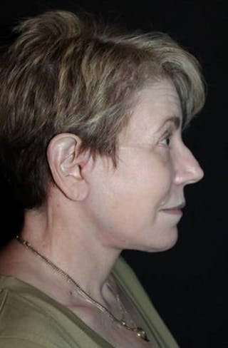 Facelift Before & After Gallery - Patient 384909 - Image 10