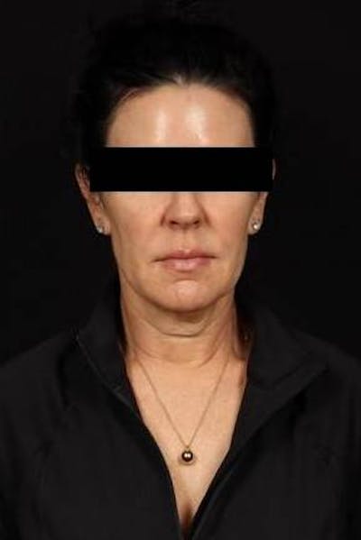 Facelift Before & After Gallery - Patient 373299 - Image 1