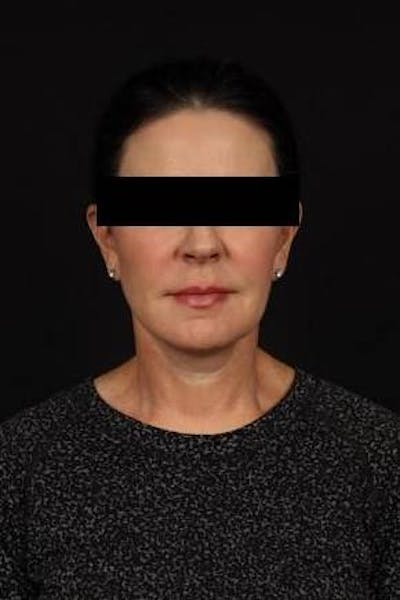 Facelift Before & After Gallery - Patient 373299 - Image 2