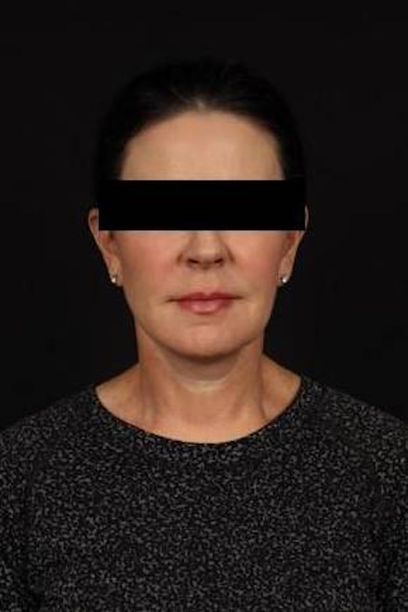 Facelift Before & After Gallery - Patient 373299 - Image 2