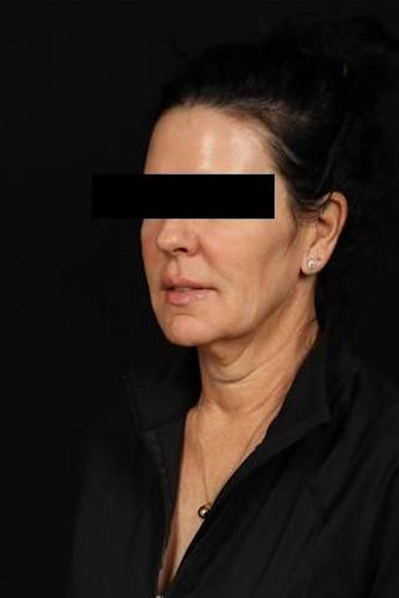 Facelift Before & After Gallery - Patient 373299 - Image 3