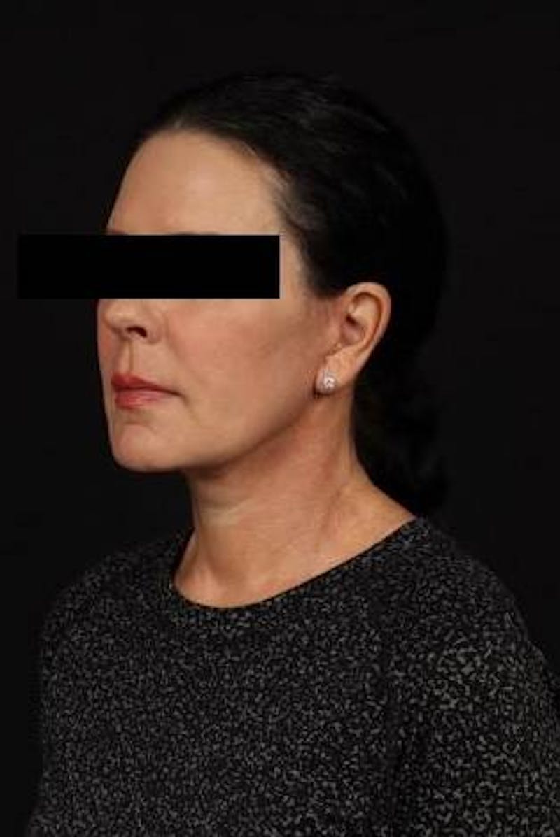 Facelift Before & After Gallery - Patient 373299 - Image 4