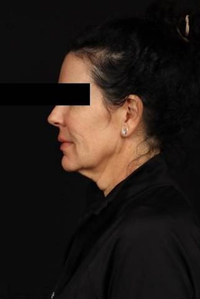 Facelift Before & After Gallery - Patient 373299 - Image 5