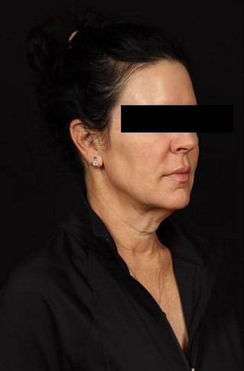Facelift Before & After Gallery - Patient 373299 - Image 7