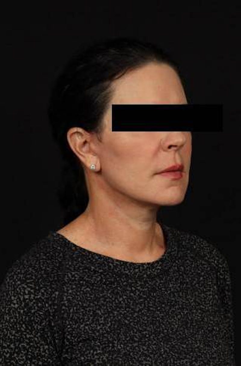 Facelift Before & After Gallery - Patient 373299 - Image 8