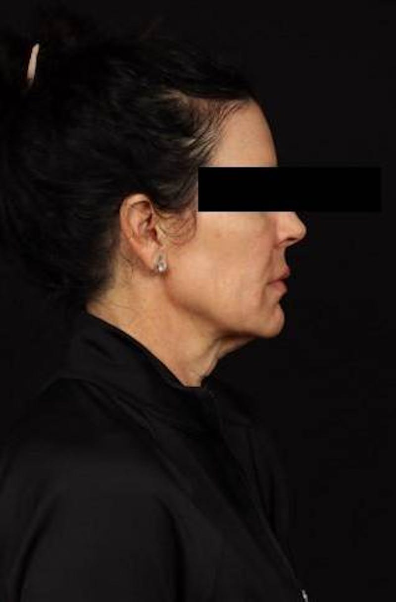 Facelift Before & After Gallery - Patient 373299 - Image 9