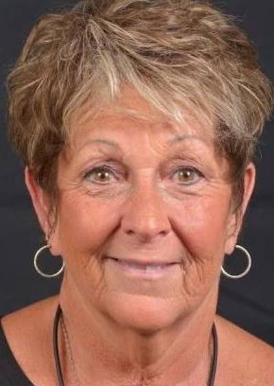 Facelift Before & After Gallery - Patient 130201 - Image 1