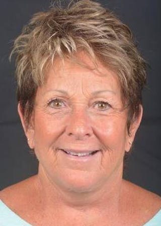 Facelift Before & After Gallery - Patient 130201 - Image 2