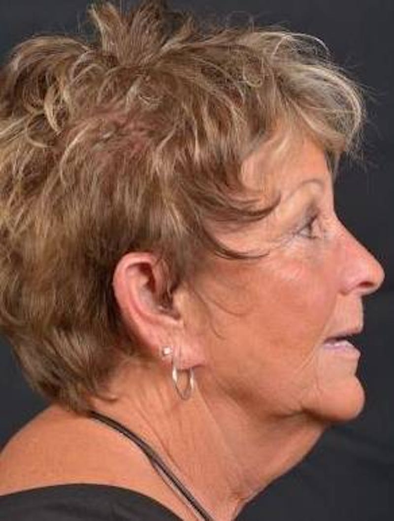 Facelift Before & After Gallery - Patient 130201 - Image 5