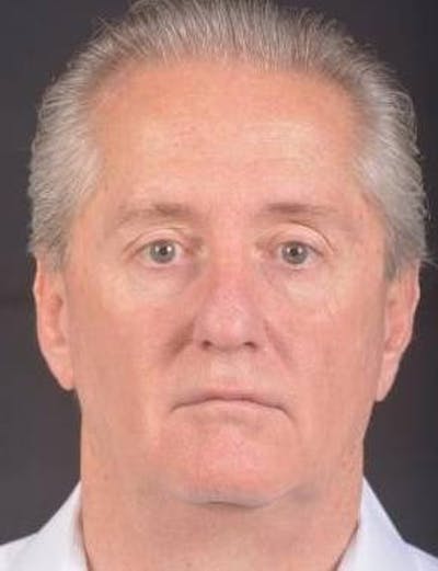 Facelift Before & After Gallery - Patient 123656 - Image 1