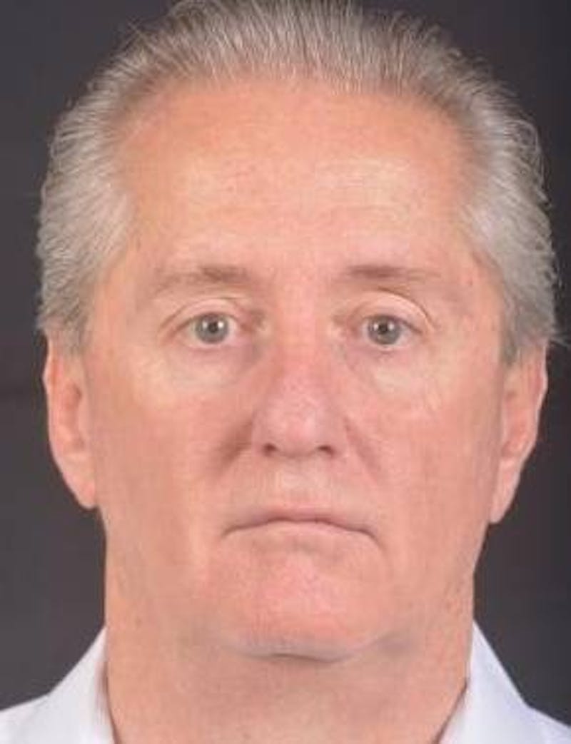 Facelift Before & After Gallery - Patient 123656 - Image 1