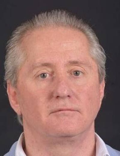 Facelift Before & After Gallery - Patient 123656 - Image 2