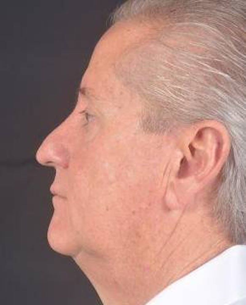Facelift Before & After Gallery - Patient 123656 - Image 3