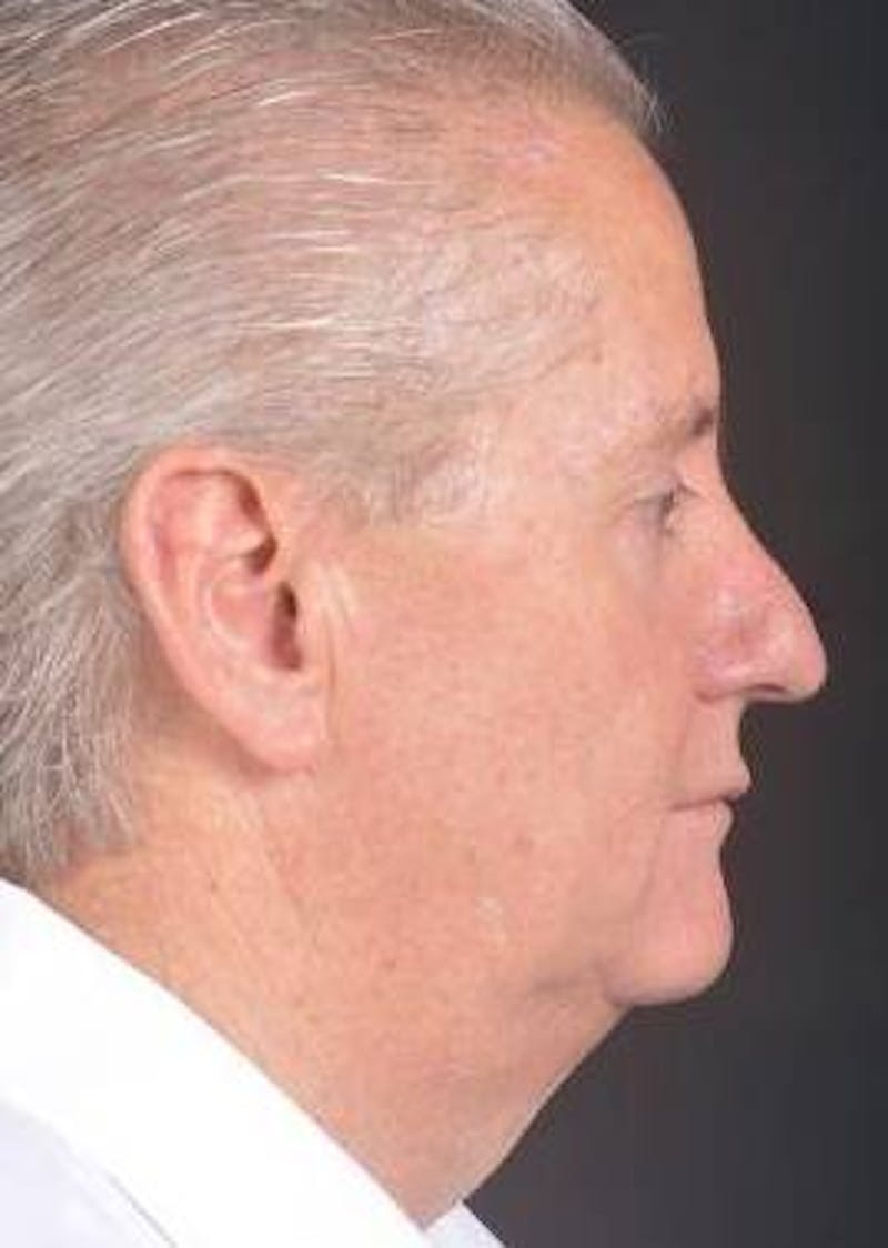 Facelift Before & After Gallery - Patient 123656 - Image 5