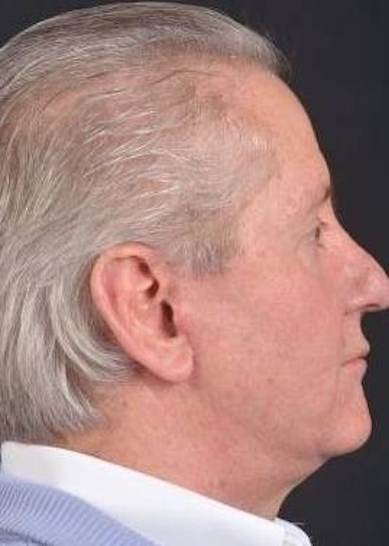 Facelift Before & After Gallery - Patient 123656 - Image 6