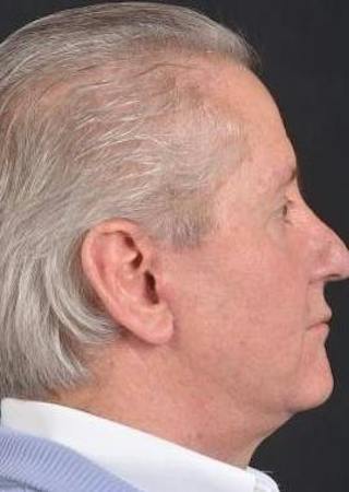 Facelift Before & After Gallery - Patient 123656 - Image 6