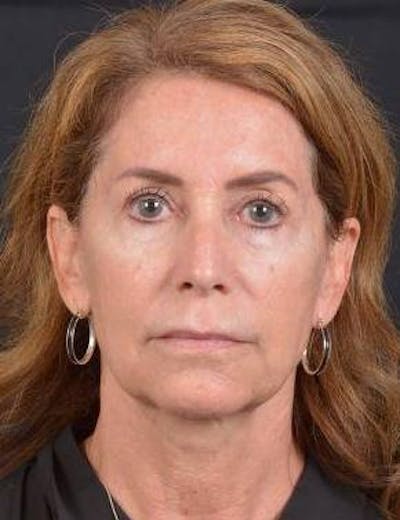 Facelift Before & After Gallery - Patient 353511 - Image 1