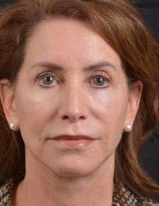 Facelift Before & After Gallery - Patient 353511 - Image 2