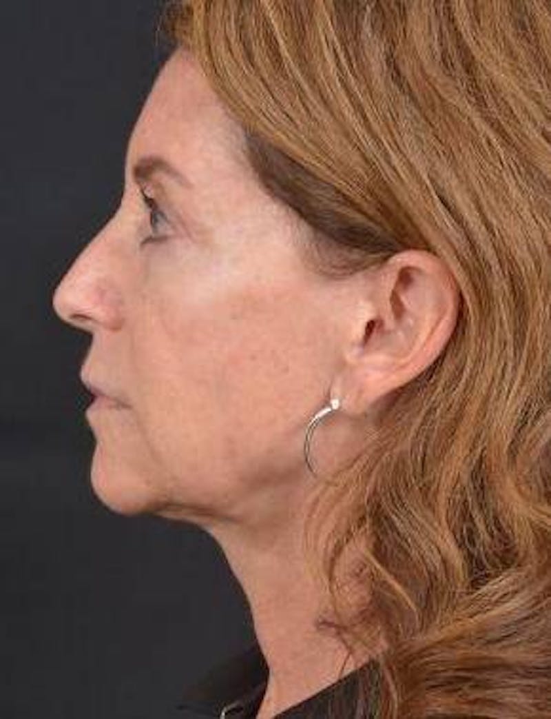 Facelift Before & After Gallery - Patient 353511 - Image 3